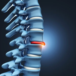 ¿Cuál es el acuerdo promedio para un accidente automovilístico con hernia de disco?